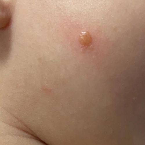 宝宝患有幼年性黄色肉芽肿该怎么办
