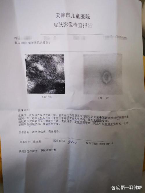 什么是猫抓病?