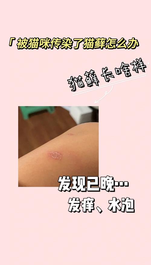 人得了猫癣可以自愈吗