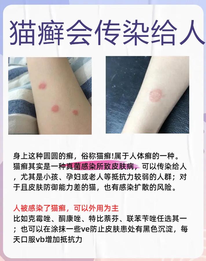 人得猫藓可以自愈吗
